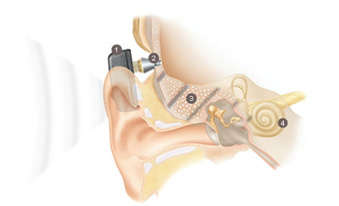 Bone-anchored hearing aid